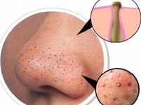 Cilt Bakımı Siyah Noktalar Tedavisi Cilt Bakımı Siyah Noktalar Tedavisi